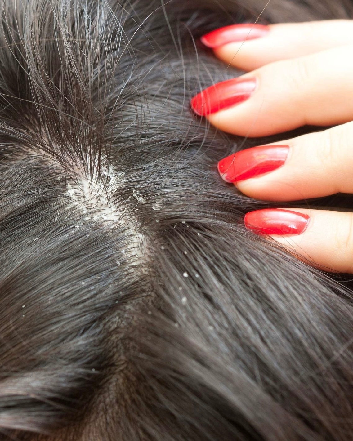 Cabello con Caspa
